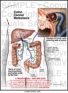 Colon Cancer Metastasis Medical Exhibit Medivisuals