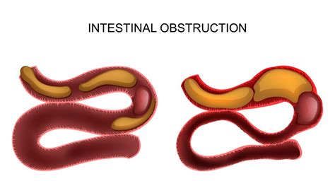 Bowel obstruction – GBMC Jordan