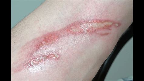 Swanson Chimpy 2nd Degree Forearm Burn, Silvadene Treatment - YouTube