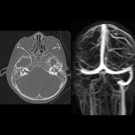 Superior Sagittal Sinus Thrombosis