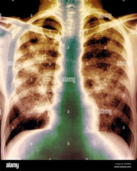 Lung silicosis. Coloured X-ray of the lungs of a patient with silicosis ...