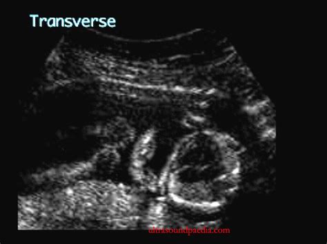 Pulmonary hypoplasia – ULTRASOUNDPAEDIA