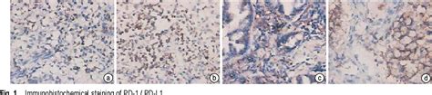 Figure 1 from Expression of PD-1/PD-L1 in lung adenocarcinoma and its ...