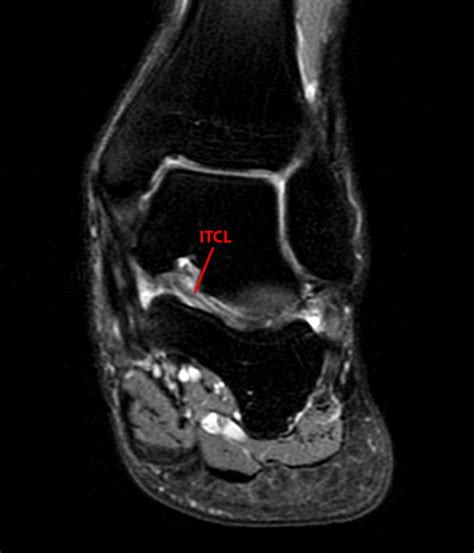 Sinus Tarsi Syndrome Mri