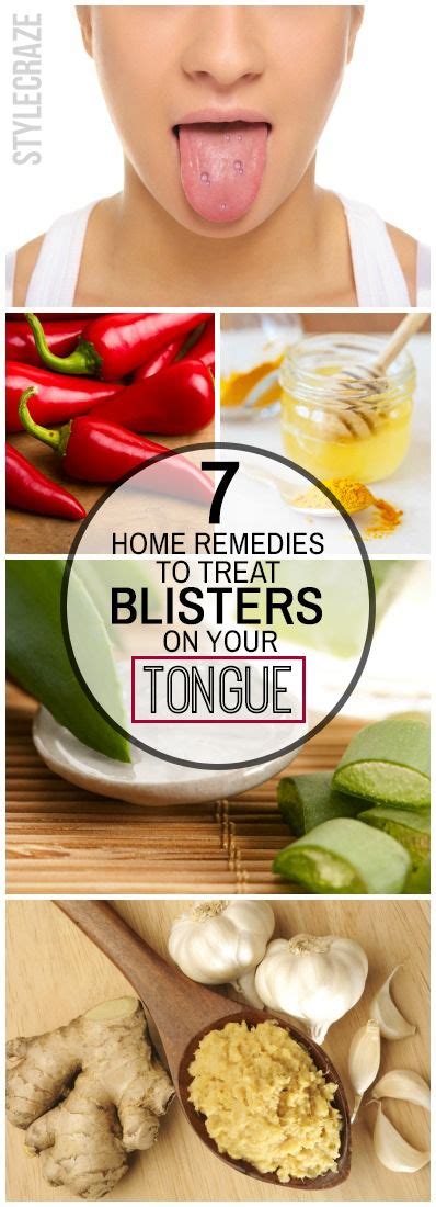 16 Home Remedies To Get Rid Of Blisters On The Tongue + Causes And ...