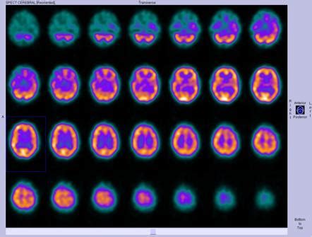 Radiotracers for SPECT brain imaging | Radiology Reference Article | Radiopaedia.org
