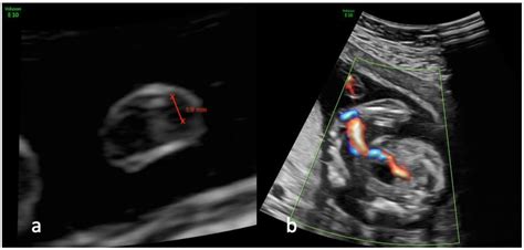 Umbilical Artery Ultrasound