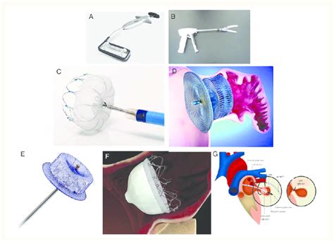 Devices for surgical left atrial appendage closure. (A) AtriClip system... | Download Scientific ...