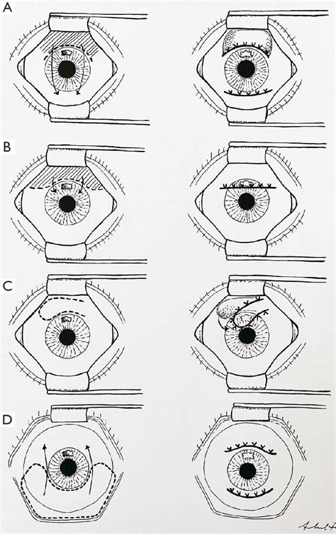 Conjunctival flap techniques. (A) Bipedicle flap; (B) partial/limbal ...