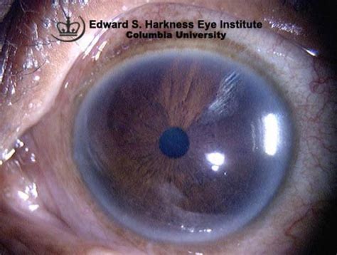 Corneal Arcus | Vagelos College of Physicians and Surgeons