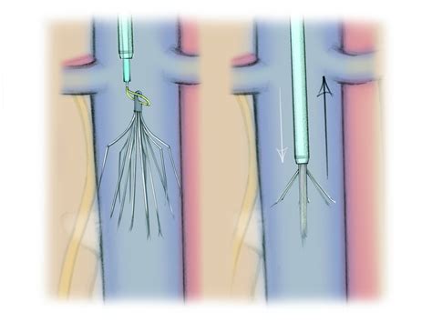 IVC Filter Removal — The Interventional Initiative