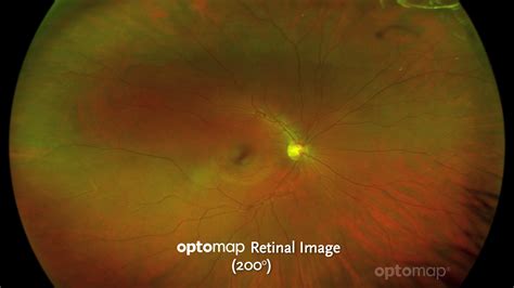 optomap Retinal Imaging - Eye Encounters