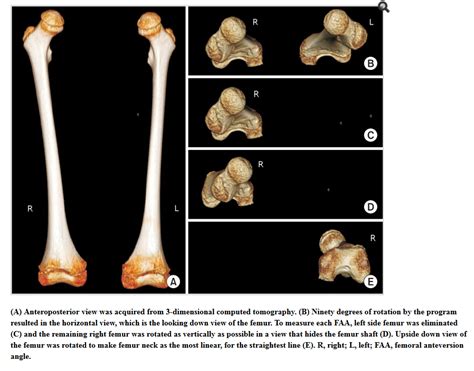 Femoral Anteversion? — The Gait Guys