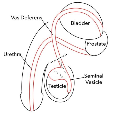 vasectomy