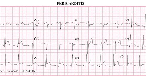 ECG Educator Blog : Pericarditis