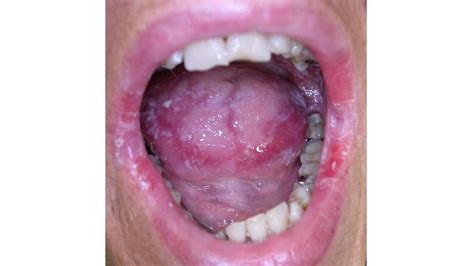 Sjogren's Syndrome Mouth Sores - Quotes Type