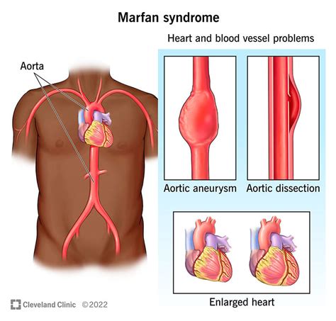 Marfan Syndrome Symptoms