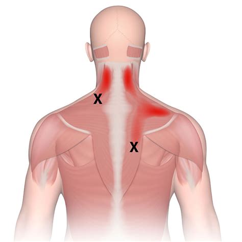 Trigger Point Injections for Back Pain NJ | Champey Pain & Spine