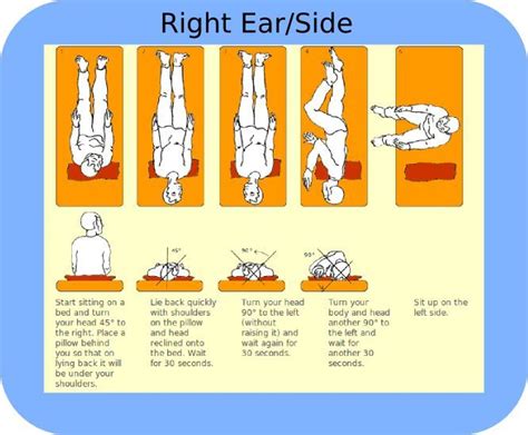 Epley Maneuver for treatment of vertigo Right Sided BPPV Treatment ...