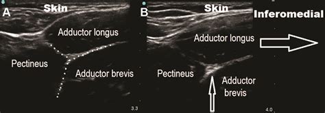 Ultrasound-Guided Obturator Nerve Block: A Proximal Interfas ...