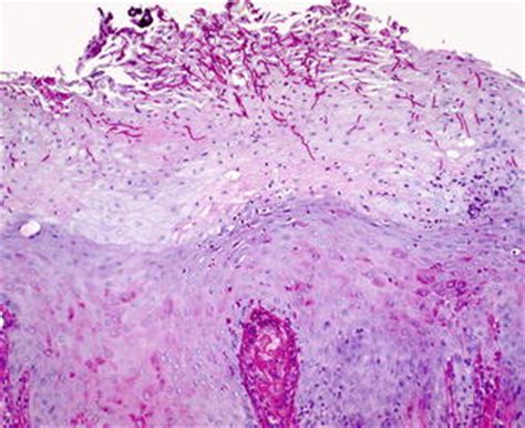 Oral Candidiasis and the Medically Compromised Patient | Pocket Dentistry