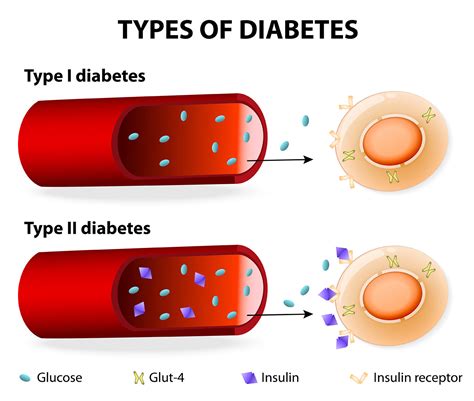 Understanding types of Diabetes Mellitus - Apollo Sugar Clinics