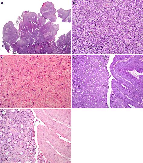 a HPV-related papillary squamous cell carcinoma of the head and neck ...