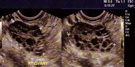 Symptoms of PCOS: How Women Were Diagnosed with Polycystic Ovary Syndrome | Men’s Health