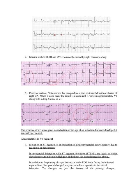 Beginners Guide for ECG Interpretation