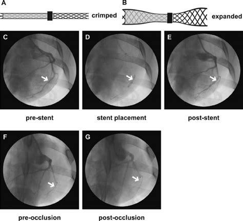 A and B : design of the stenosis stent. A : crimped bare metal stents... | Download Scientific ...