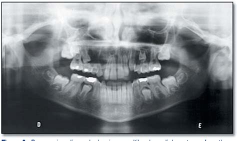 Figure 4 from Odontogenic myxoma--a case report and clinico-radiographic study of seven tumors ...