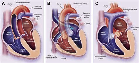 Figure 1 from Dextro-Transposition of the Great Arteries: Long-term ...