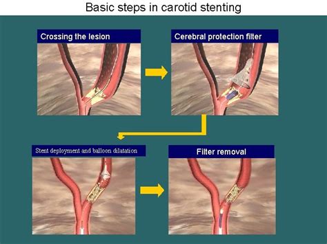 Carotid artery stenting for carotid artery stenosis Dr