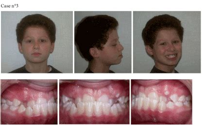 Functional treatment of maxillary hypoplasia and mandibular prognathism