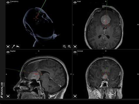 Meningioma | C.N.S. Neurosurgery