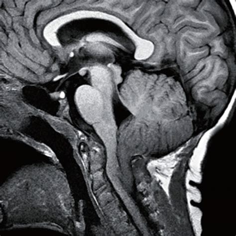 Chiari 1 malformation