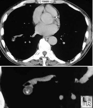 LearningRadiology - Hamartoma, Lung