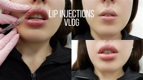 Before And After Juvederm Ultra Lipstick Review | Lipstutorial.org