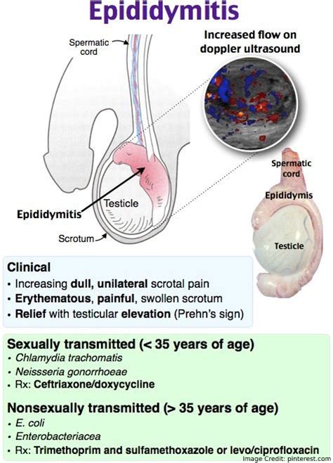 What is Epididymitis? Here’s Everything You Need to Know