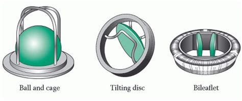 Heart Valve Repair and Replacement | Thoracic Key