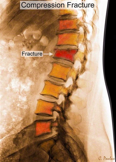 28 best Compression Fractures images on Pinterest | Med school, Medical and Bones