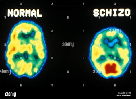 Pet scan of brain schizophrenic hi-res stock photography and images - Alamy