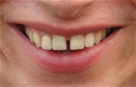 How to Fill That Gap In Your Smile « Dentist San Juan Capistrano CA ...