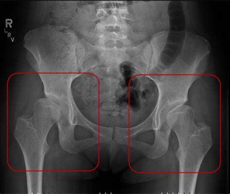 Adult Hip Dysplasia Diagnosis | International Hip Dysplasia Institute