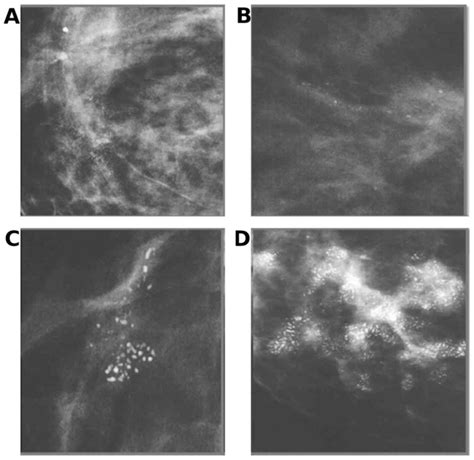 Breast microcalcifications: Past, present and future (Review)