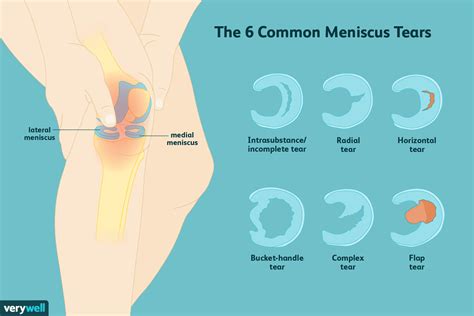 Medial Meniscus Tear, Knee Meniscus, Knee Ligaments, Knee Osteoarthritis, Knee Arthritis ...