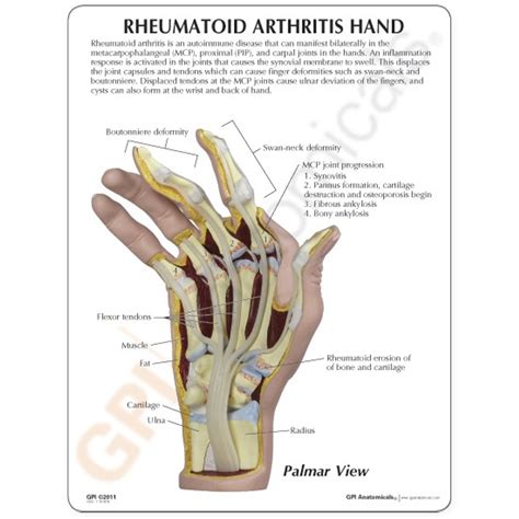 Hand Rheumatoid Arthritis Model - Clinical Charts and Supplies