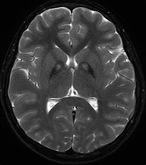 MRI Brain Scans Detect People with Early Parkinson's - Neuroscience News