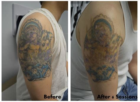 Full color tattoo removal after 6 sessions! Look at that fading! :)