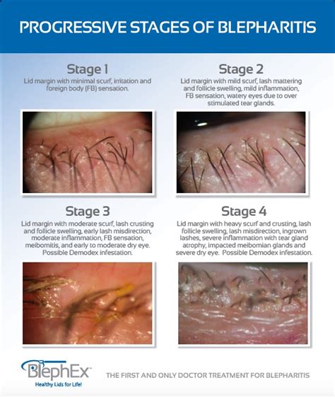 Blepharitis - Citrus Valley Eyecare